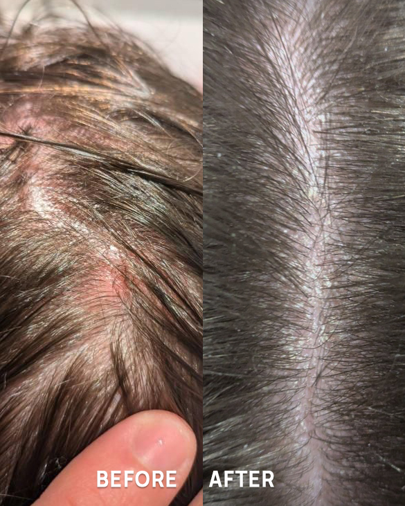 Serum za lasišče 50 ml